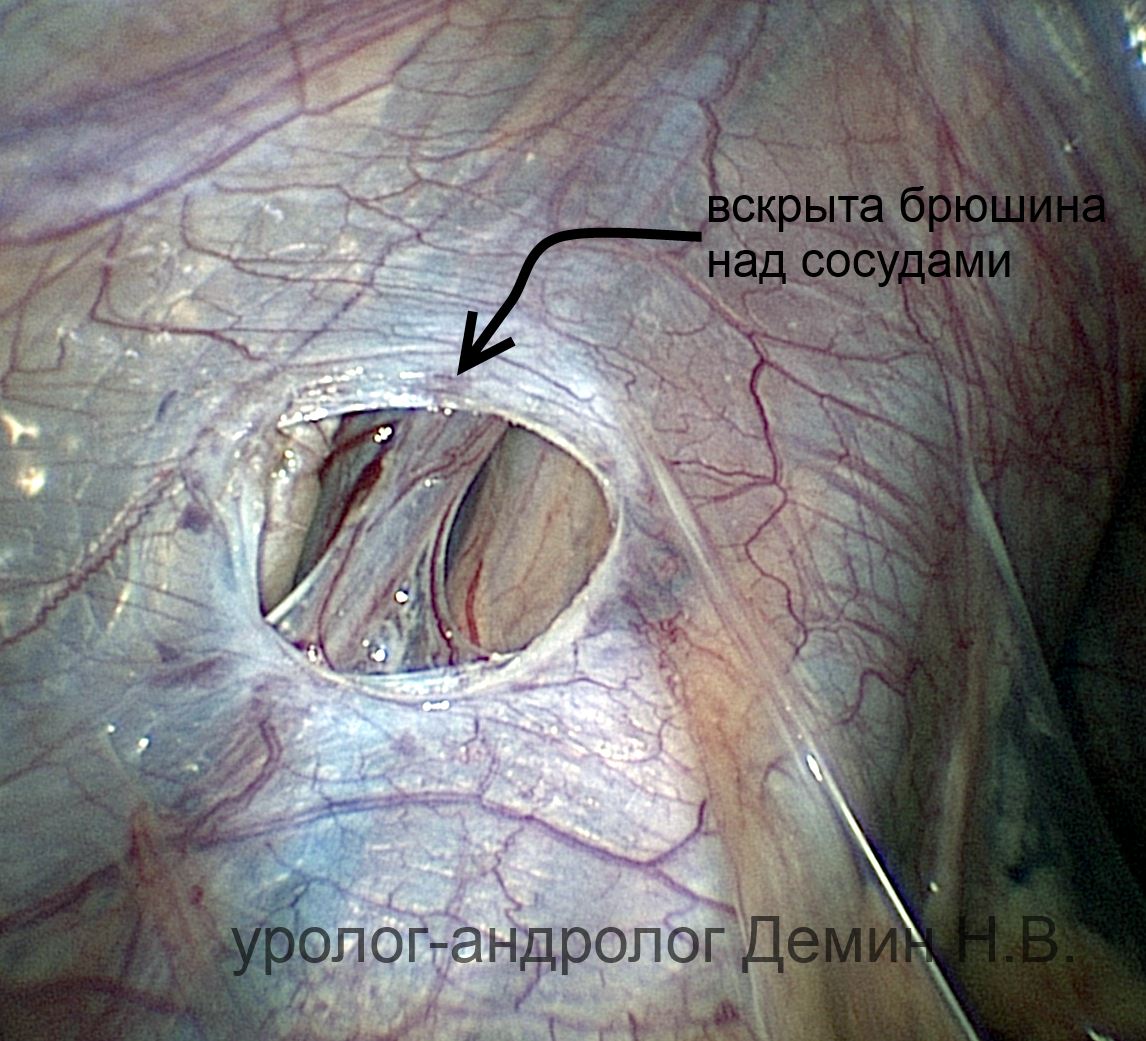 Лапароскопия, вскрытая брюшина над сосудами, фото