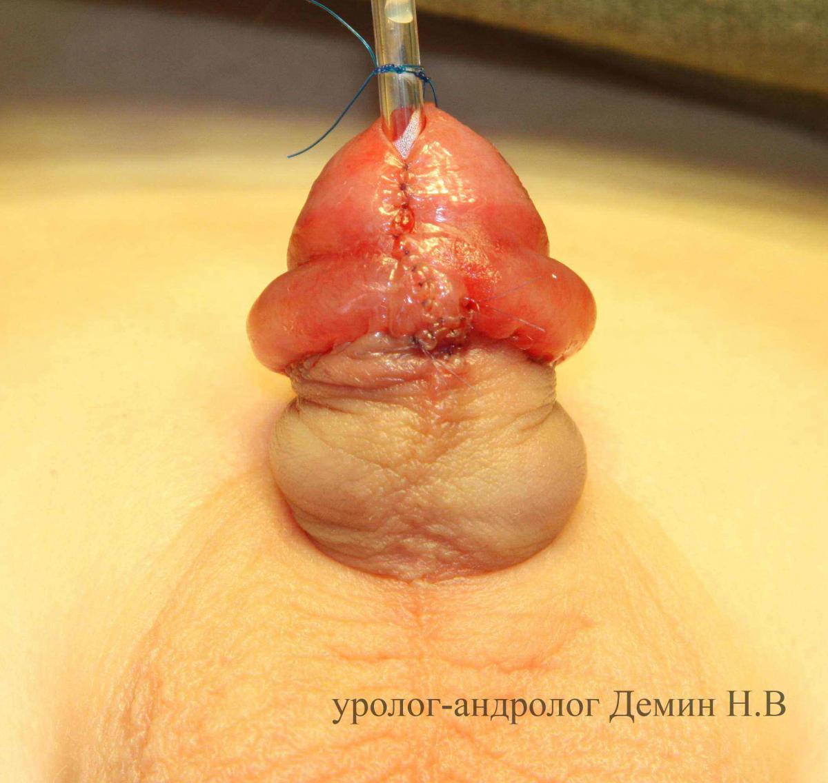 Венечная гипоспадия, фото после операции
